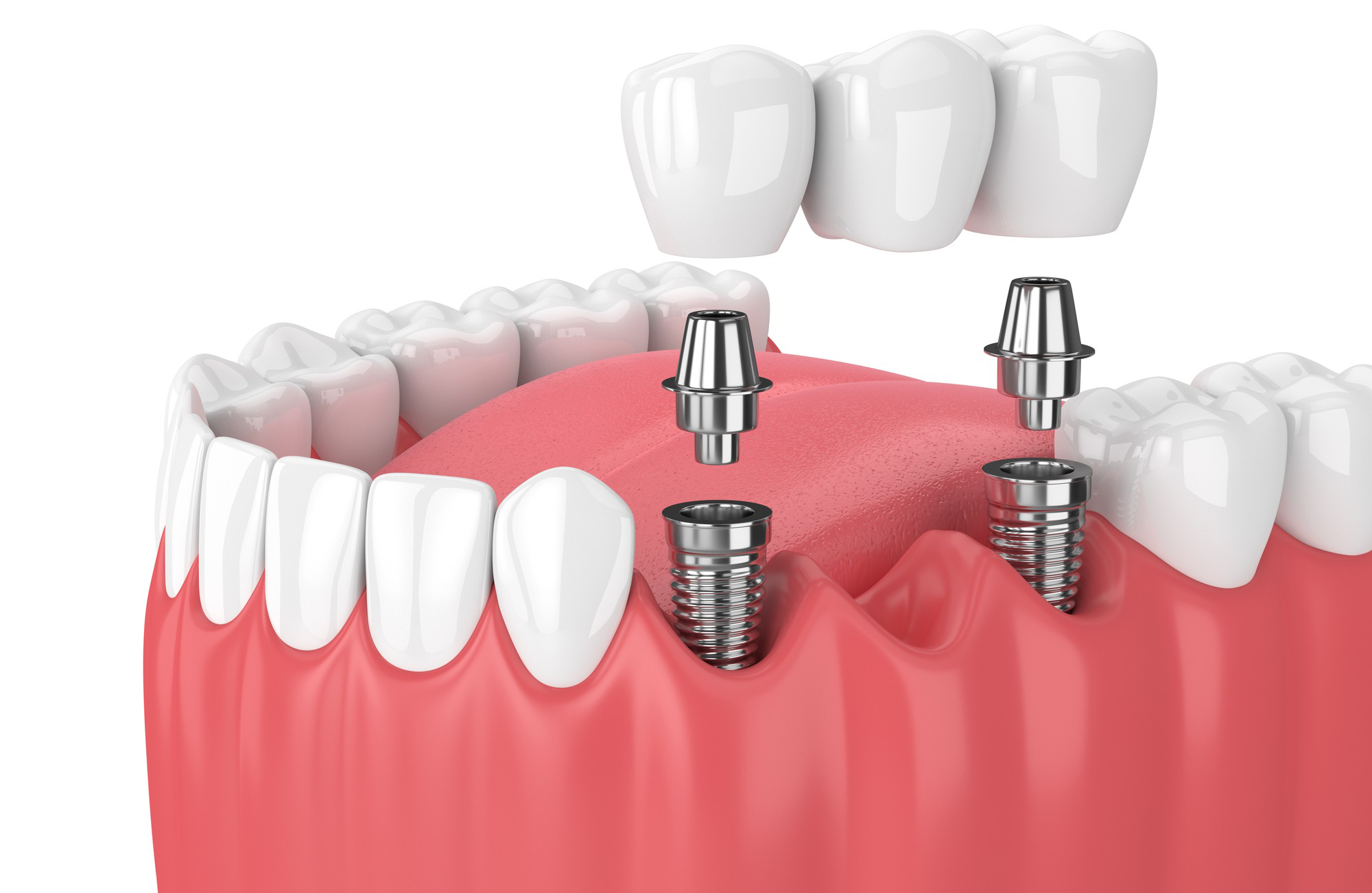 dental bridge