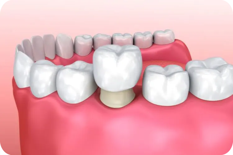 corone dentale illustrazione