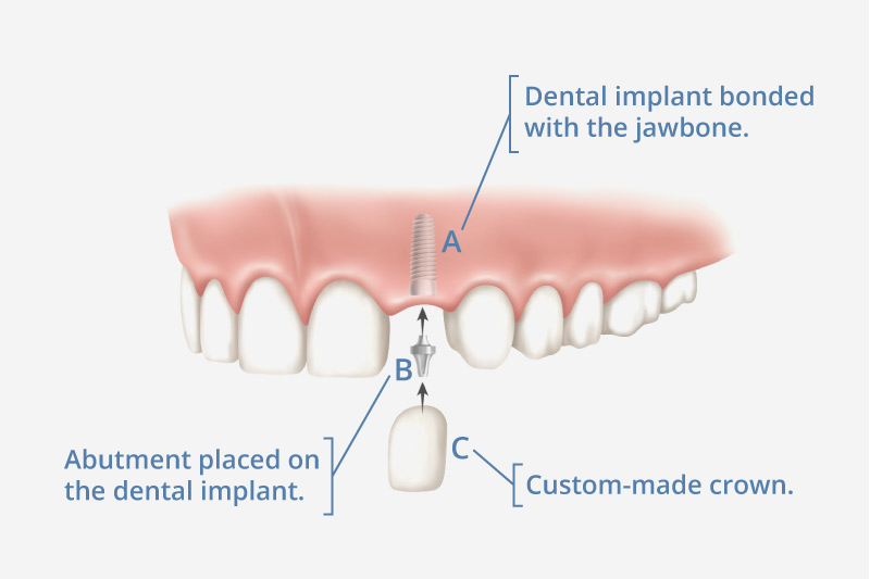 Dental Implant Illustration