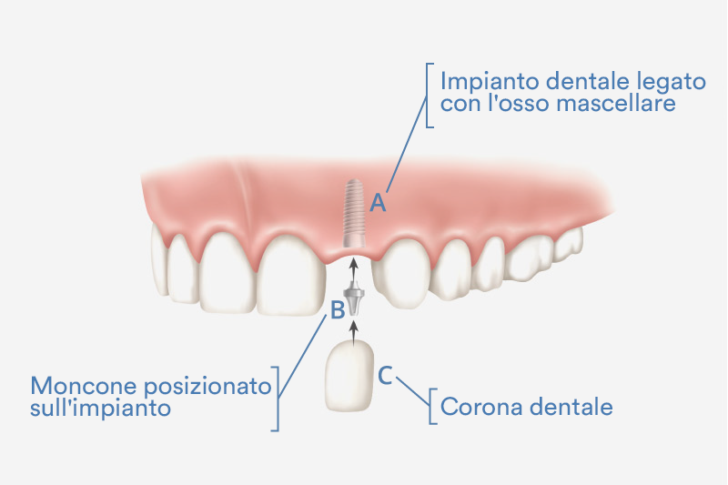 Dental Implant Illustration